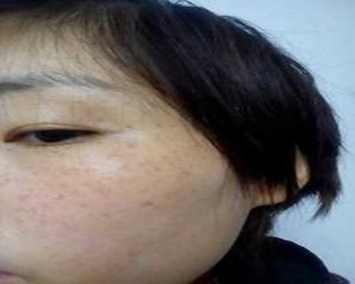 怎么治疗色斑有效
