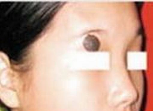 色素痣症状表现具体如下