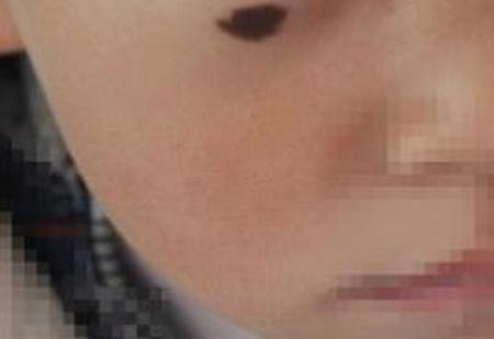 黑痣怎么去除