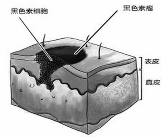 色素痣怎么治疗