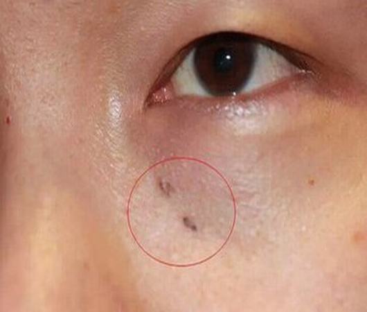 怎样消除黑色素痣