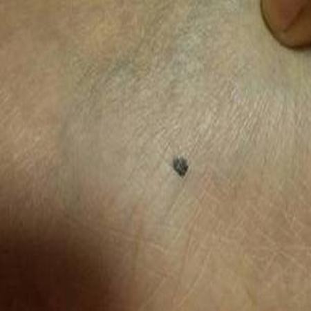 鼻子上有色素痣