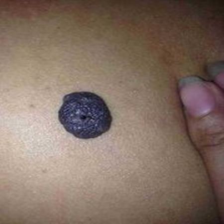 混合型色素痣是什么