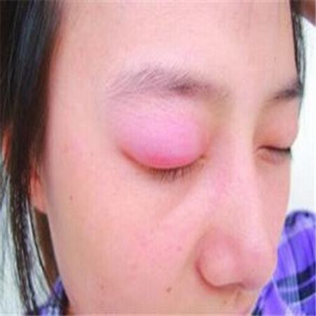 色素痣的病因