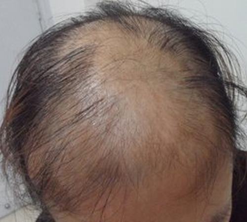预防脱发的方法有哪些