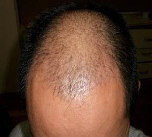 脂溢性脱发的传统治疗