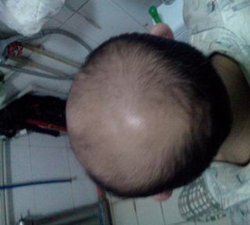 脂溢性脱发怎么治疗好