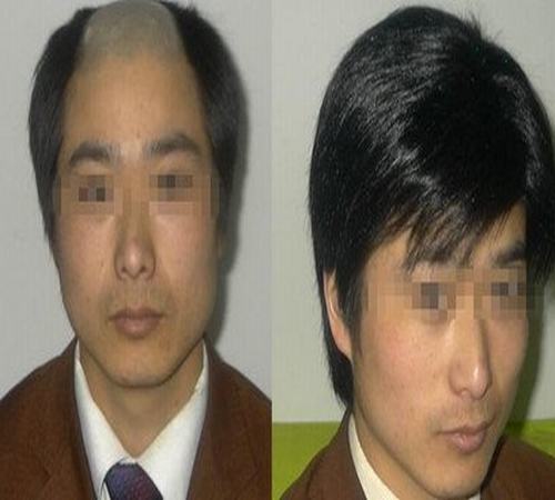 脱发的人日常生活中该怎么正确护理呢