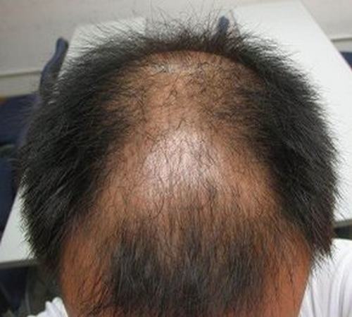 关于脱发的原因有哪些的一个介绍