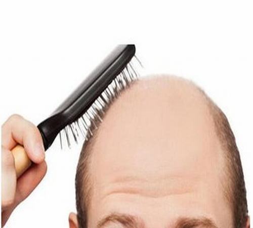 脱发是由什么原因形成的
