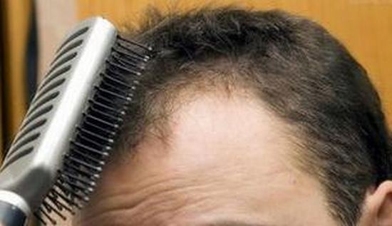 男性该如何防止脱发