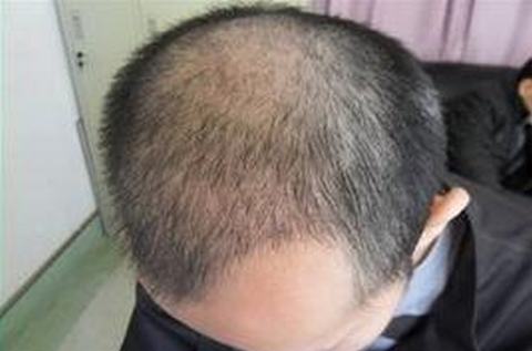 脱发最好的治疗的手法是什么