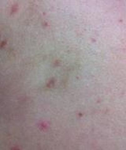 外阴湿疹的预防方法是哪些
