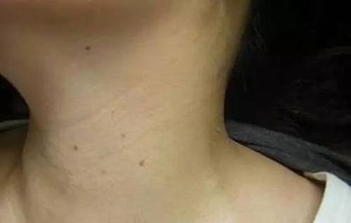 预防颈痈疾病很关键