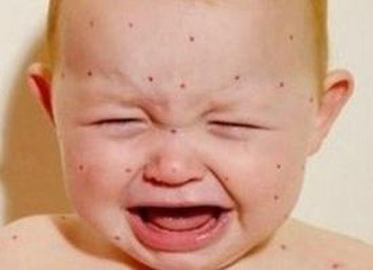 小儿过敏性紫癜治疗需要注意什么