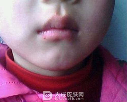 婴儿血管瘤