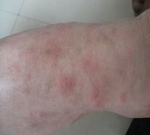 胆碱性荨麻疹是怎么引起的