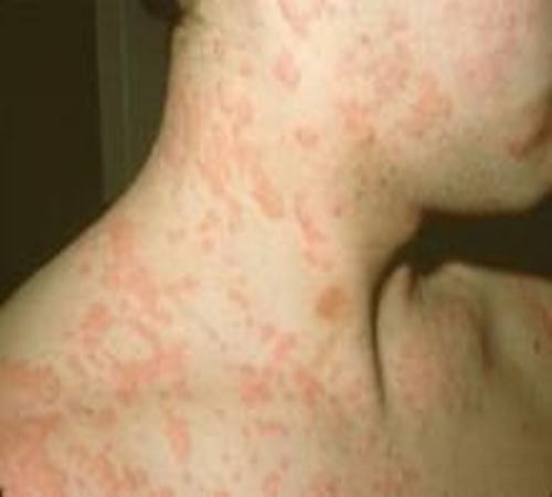 关于荨麻疹的发病原因