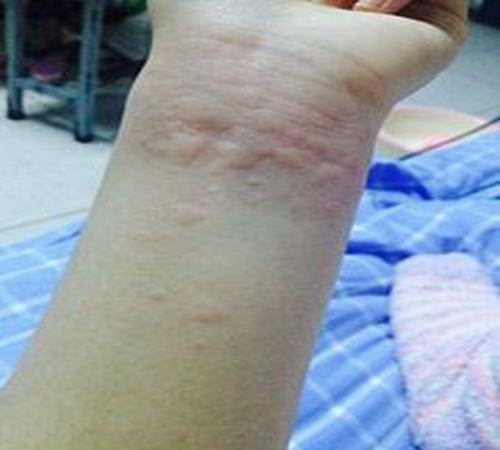 具体过敏性荨麻疹有哪些症状呢