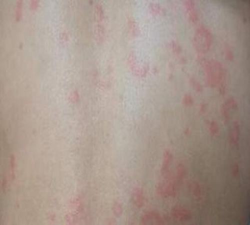 皮肤病医院荨麻疹有效治疗方法