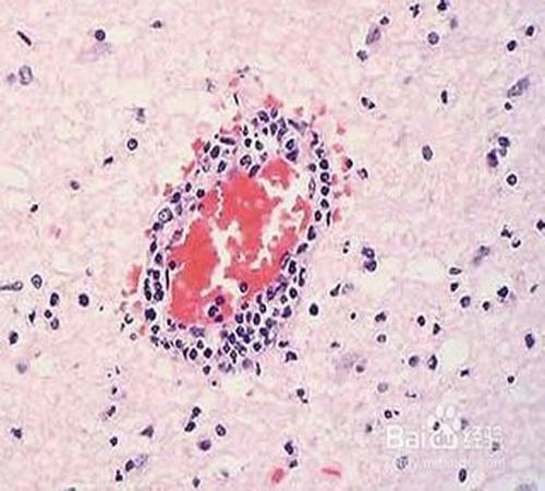 丘疹类荨麻疹的详细原因是什么