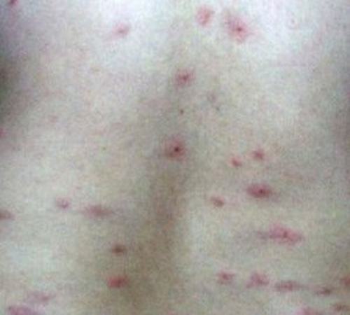 为什么夏季夏季容易患寒冷性荨麻疹