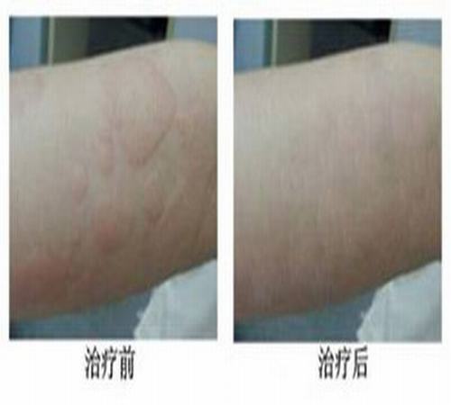 大米也会引发荨麻疹