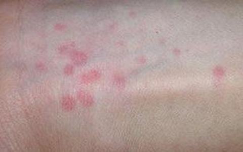 通常治疗荨麻疹的方法都有什么呢