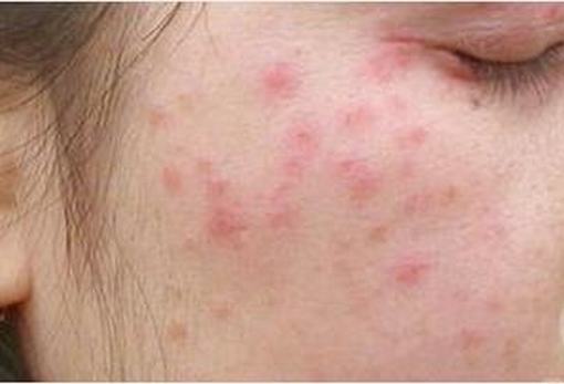 荨麻疹有哪些常见病因呢