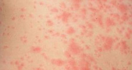 患有荨麻疹型药疹的原因是什么