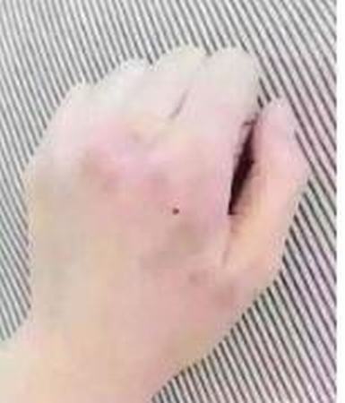 遗传过敏性皮炎的并发症都有哪些呢