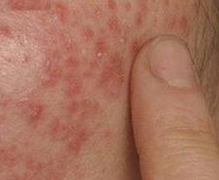 泛发性遗传过敏性皮炎有什么症状