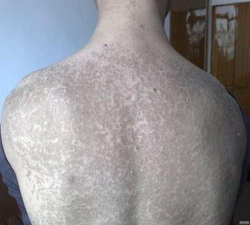 鱼鳞病与身体内部血液的关系