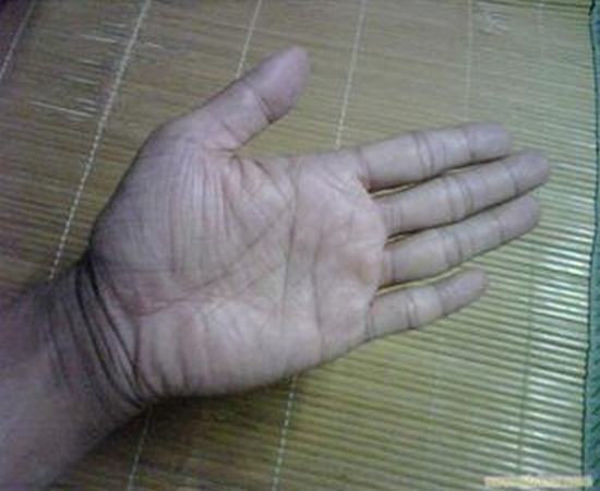 鱼鳞病的相关综合征