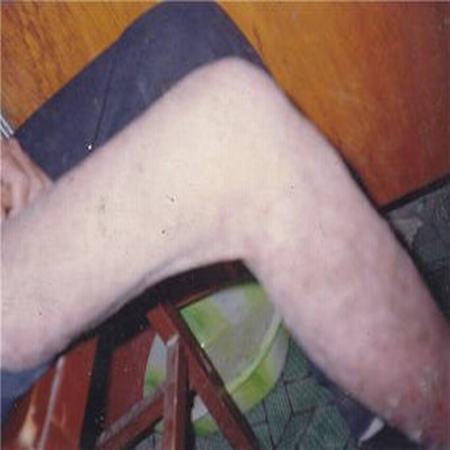 具体介绍如何预防鱼鳞病的发生