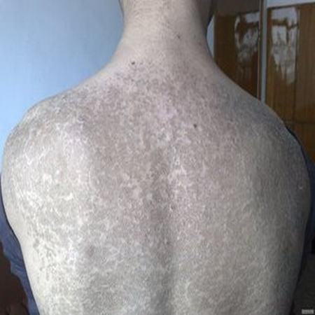 鱼鳞病的并发症是哪些