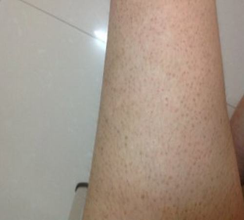 鱼鳞病的遗传率