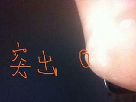 多发性脂肪瘤怎么治