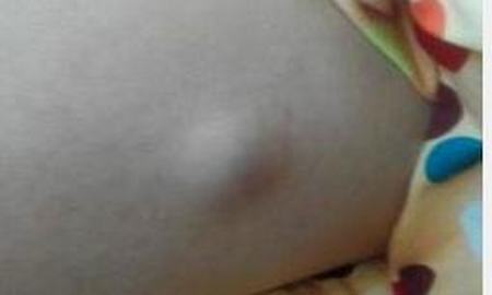 颅内脂肪瘤的病理与组织学特点如何