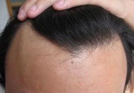 脂溢性脱发的临床症状是什么表现