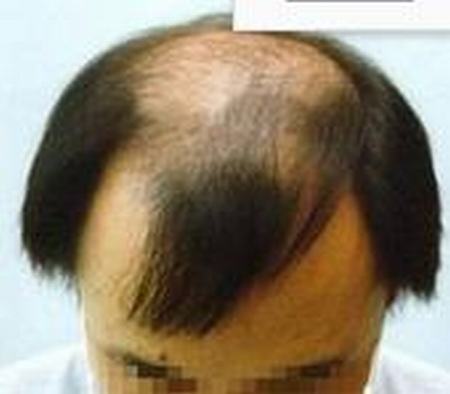 脂溢性脱发的症状都有哪些
