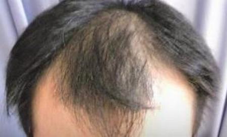 患上脂溢性脱发要怎么办