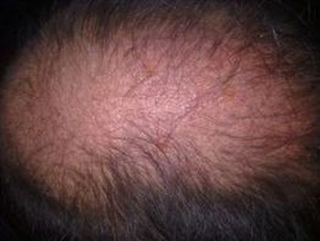 急慢性脂溢性脱发如何的区分与治疗