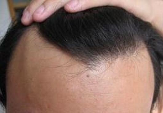 中医如何治疗脂溢性脱发呢