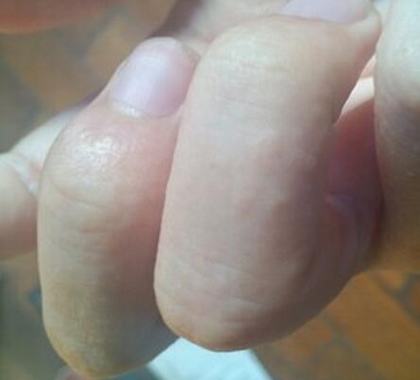 无极膏能治汗疱疹吗