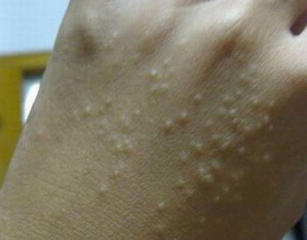 汗疱疹的日常预防措施是什么