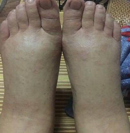 为什么宝宝会长汗疱疹