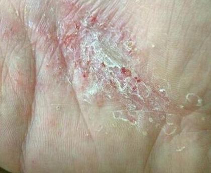 手指汗疱疹早期的症状都有什么呢