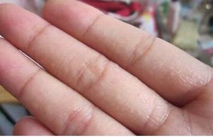 手上汗疱疹注意的问题