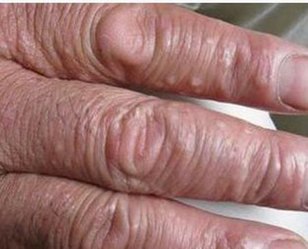 汗疱疹的治疗的手法和必须多加注意